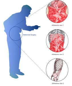 Image 28 - -surgery-adhesions