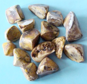 Gallstones