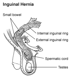 Inguinal hernia